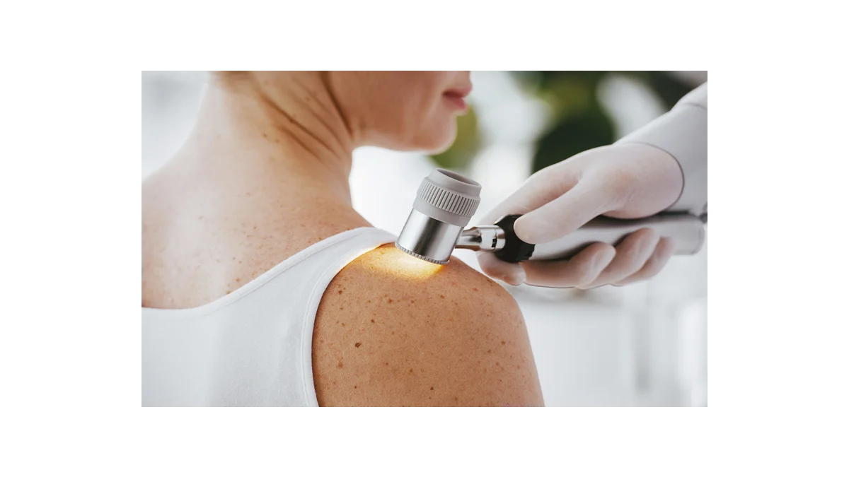 BENU a prevence melanomu: Alarmující čísla